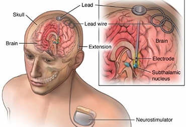 Functional Neurosurgery In Thane