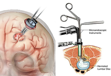 Minimally Invasive Brain And Spine Surgery In Thane