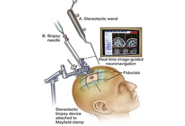 Neuronavigation Surgery In Thane