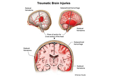 Traumatic Brain Surgeries In Thane